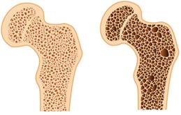 az ágyéki csontritkulás kezelésének eszközei hogyan kezeljük a térd 1. fokú artritiszét