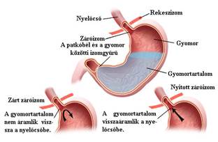 Magas vérnyomás és reflux tünetek - Reflux és gyomorfekély