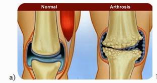 az artrózis kombinált kezelése