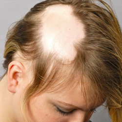 magas vérnyomás és alopecia)