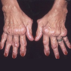 a kéz kis ízületeinek rheumatoid arthritis kezelése